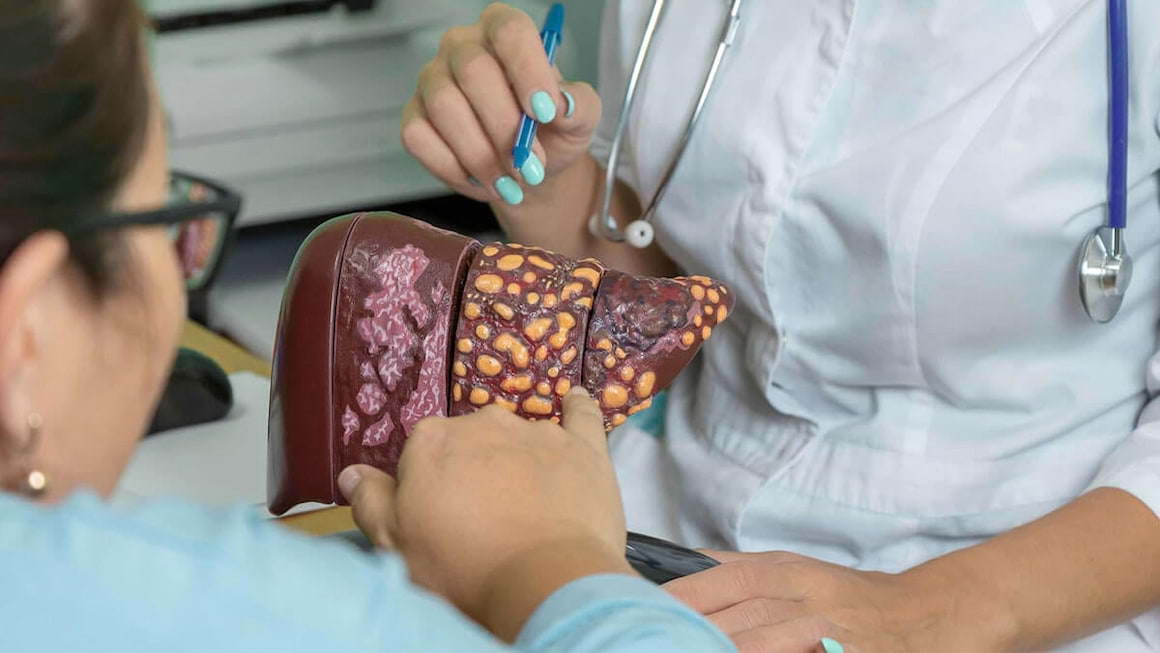 Exista sau nu un tratament standard pentru steatoza hepatica?